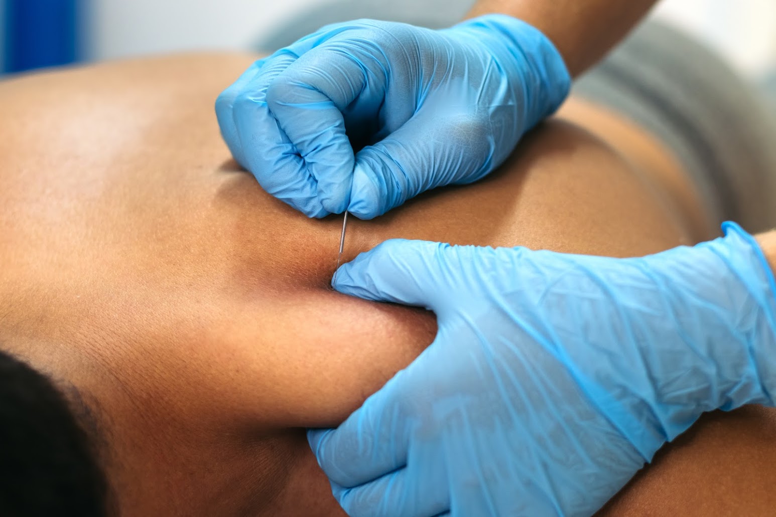 punción seca fisioterapia dolor muscular quineon madrid